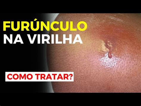 Fur Nculo Na Virilha Furunculose Como Tratar Saiba Youtube