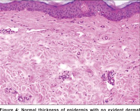 Figure 4 From Acquired Cutis Laxa Associated With Light And Heavy Chain