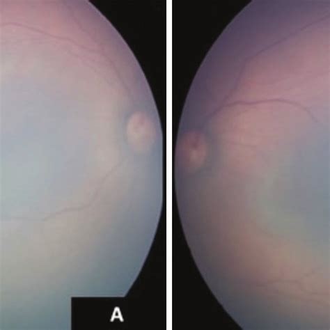 Color Fundus Photographs Of The Right A And Left B Eye After Laser