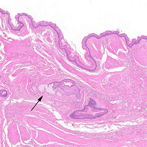 Histologic Cross Section Of Dermoid Cyst Wall With Arrow Pointing To