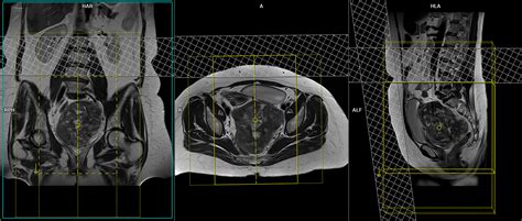 Uterine Fibroid MRI Protocol | Fibroid Mapping MRI Protocol and Planning