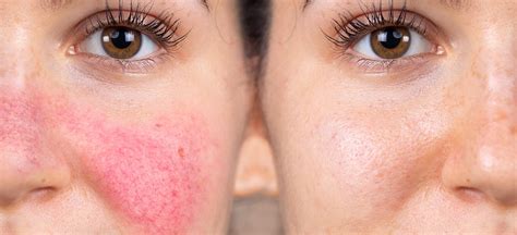 Acne And Rosacea Know The Difference Acne Treatment