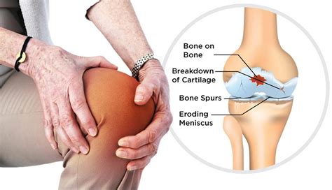 Osteoarthritis Causes Symptoms Diagnosis Prognosis Treatment