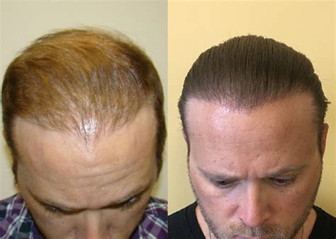 Complete Crown Coverage Incredible Hair Transplant Results