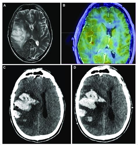 Case 2 A Axial Brain Magnetic Resonance Imaging MRI T2 Weighted