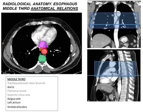 Figure 2 From Esophageal Cancer Anatomical Features Current