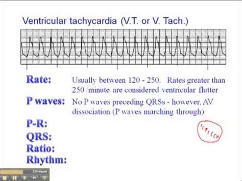 Ventricular Tachycardia Ecg