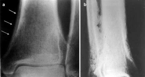 Hypertrophic Osteoarthropathy | Musculoskeletal Key