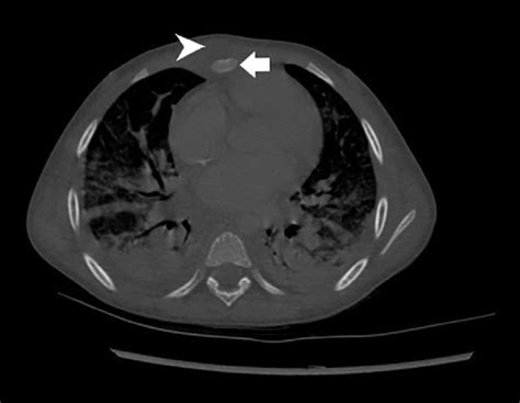 Chest Computed Tomography White Arrow Indicates Osteomyelitis Of The