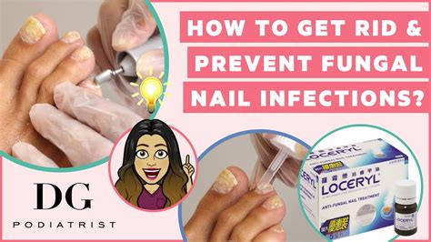 How To Get Rid And Prevent Toenail Fungus Youtube