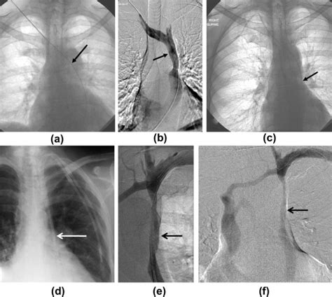 Imaging And Management Of Complications Of Central Venous Catheters