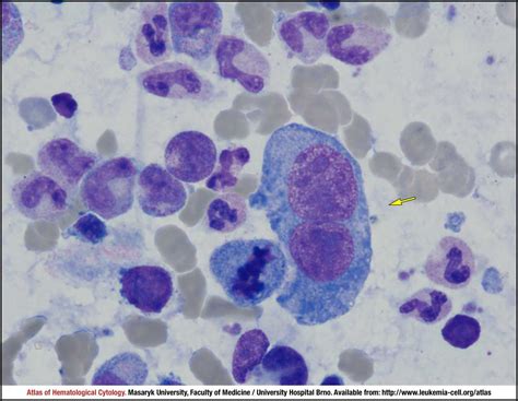 Classic Hodgkin Lymphoma Cell Atlas Of Haematological Cytology