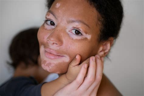 Vitiligo Hastalığı Nedir Hipokrat Online