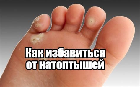 Как избавиться от натоптышей в домашних условиях?