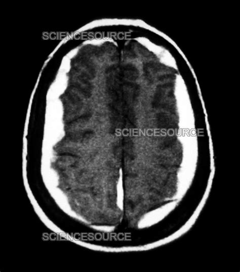 Photograph Mri Of Bilateral Subdural Hematomas Science Source Images