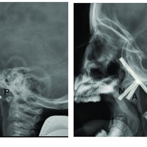 Lateral Cephalometric X Ray Findings A Nasopharynx Without Adenoid