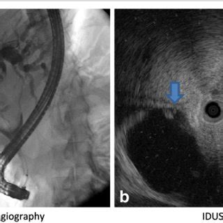 A Cholangiogram Shows A Large Oval Shaped Filling Defect Arrow In The