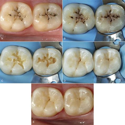 9 Direct Composite Restorations Pocket Dentistry