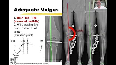 High Tibial Osteotomy Hto By Dr Mangal Parihar Youtube