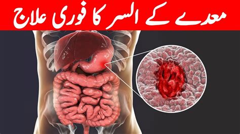 Stomach Ulcer Symptoms Treatment Stomach Ulcer Ka Ilaj Maida Ke