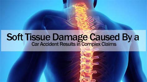 Soft Tissue Damage Caused By A Car Accident Results In Complex Claims