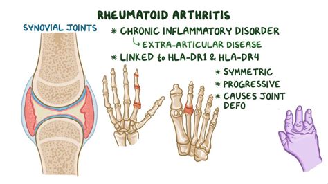 Rheumatoid Arthritis Joint