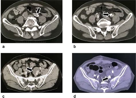 Computed tomography of an isolated internal iliac artery aneurysm ...