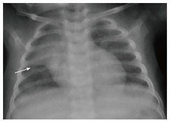 Imaging Of The Pediatric Thymus Clinicoradiologic Approach