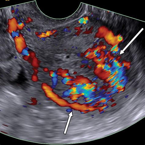 Gestational Trophoblastic Disease Clinical And Imaging Features Radiographics