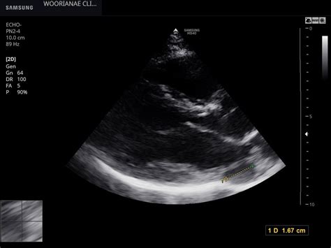 관정맥동 Coronary Sinus 보다는 쿠마딘 능선 Coumadin Ridge 좌심방 내부에