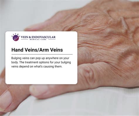 Hand Veinsarm Veins Vein And Endovascular Medical Care