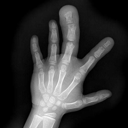 Playlist Congenital Hand Anomalies By Dr Andrew Dixon