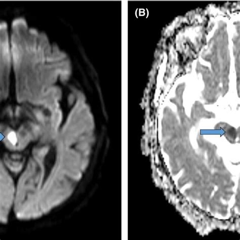 MRI head showing hyperintense lesion on FLAIR weighted image in the ...