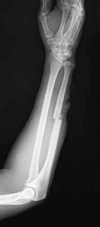 Ulna Fracture Radiology Case Radiopaedia Org