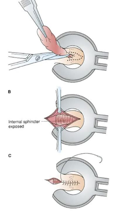 Hemorrhoid Removal General Surgery Brightside Specialty Clinics