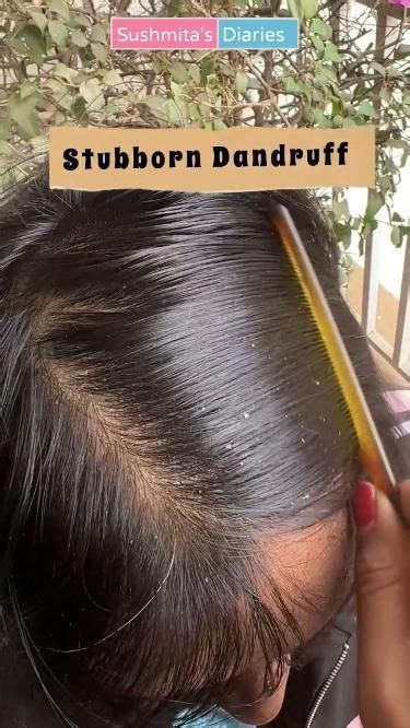 10 Best Tips To Get Rid Of Dandruff Fast Permanently At Home