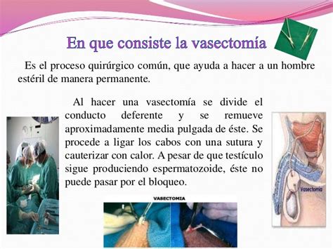 Vasectomia