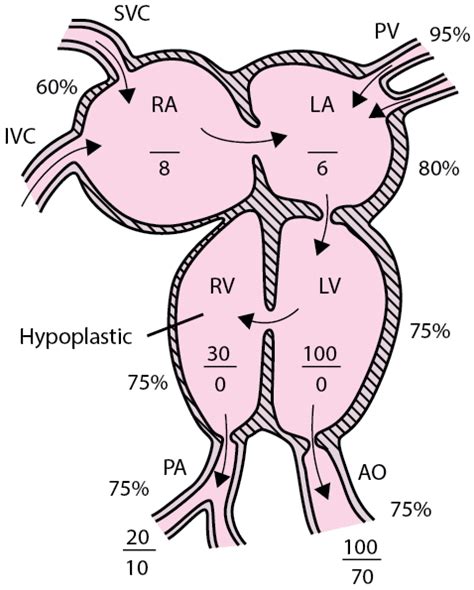 Tricuspid Atresia - Pediatrics - MSD Manual Professional Edition