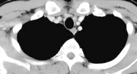 B Enhanced Chest Computed Tomography Scan After The Fourth Cycle Of