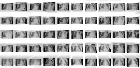 Chest X Ray Image Dataset Machine Learning Datasets