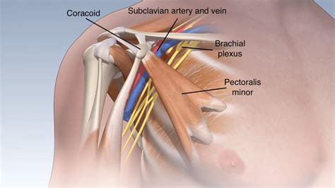 Pectoralis Minor Syndrome A Relatively Unknown Condition With A Somewhat Simple Solution