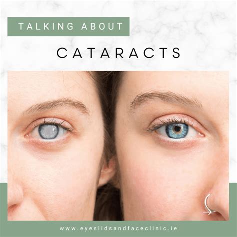 Demystifying Cataracts: Causes, Symptoms, and Treatments