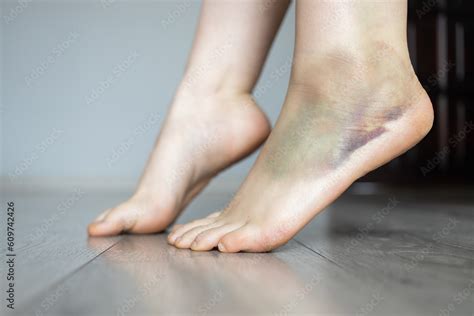 Leg With Hematoma Foot With Hematoma Ankle With Bruise Twisted Ankle