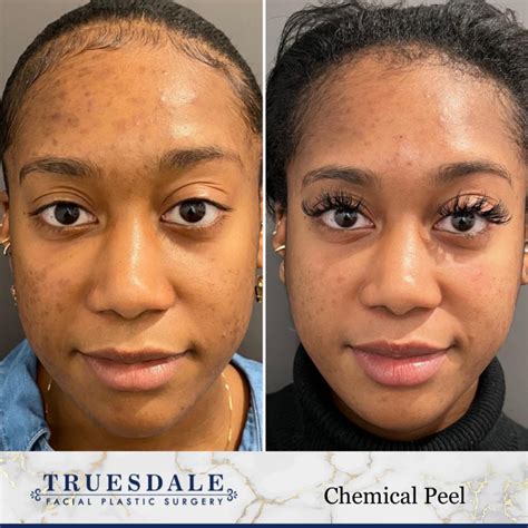 Chemical Peels Beverly Hills Truesdale Facial Plastic Surgery