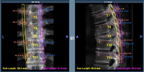 C Preoperative Planning Of The Robotic Assisted Pedicle Screw