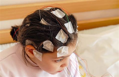 Epilepsia en Niños La importancia de conocer esta enfermedad CENI