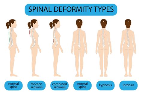 Spine Deformation Types And Healthy Spine Comparison Diagram Poster With Backbone Curvatures