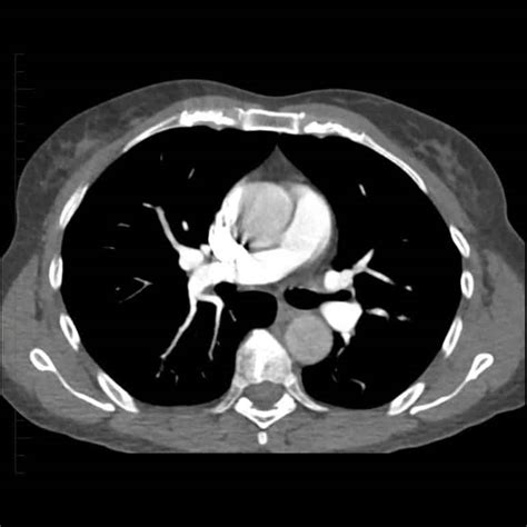 CT Scan With IV Contrast Patient Fact Sheet