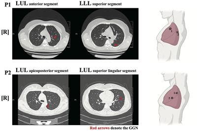 Frontiers The Diagnosis Of Intrapulmonary Metastasis Multifocal