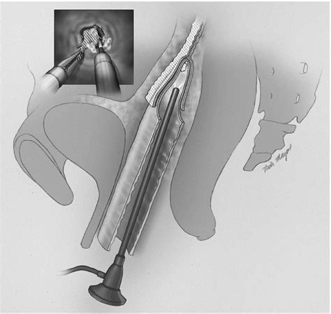 Vaginoscopy With Laser Treatment Of Symptomatic Upper Vaginal Mesh